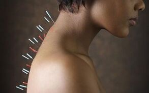 Acupunctură