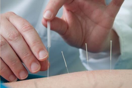 Acupunctura este o metodă de tratare a durerii în regiunea lombară cauzată de osteocondroză