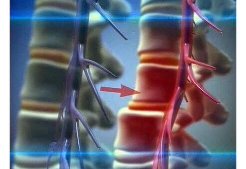 Comprimarea terminațiilor nervoase în osteocondroza lombară
