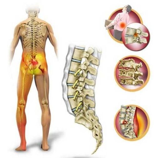 Osteocondroza coloanei lombare, care provoacă dureri de spate