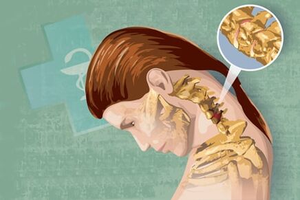 simptome reflexe ale osteocondrozei