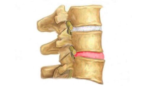 Proeminența discului intervertebral al coloanei vertebrale - un semn de osteocondroză