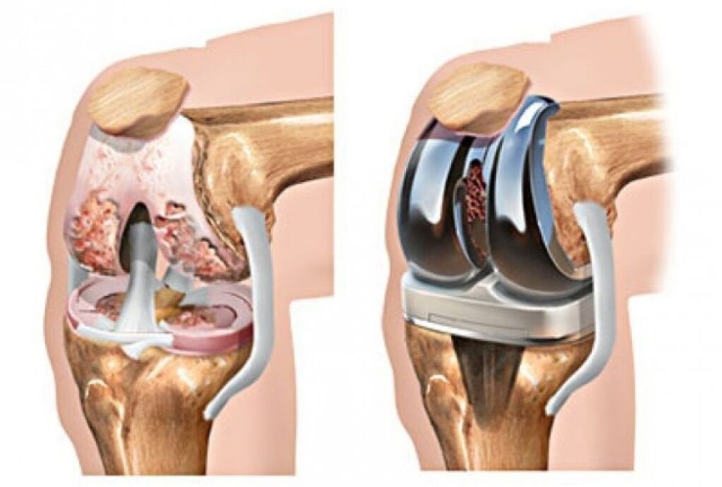 artroplastie de genunchi pentru artroză