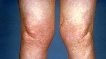 deformarea articulațiilor genunchiului cu artroză