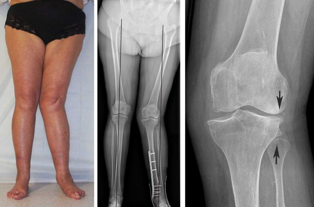 tabloul clinic al osteoartritei genunchiului