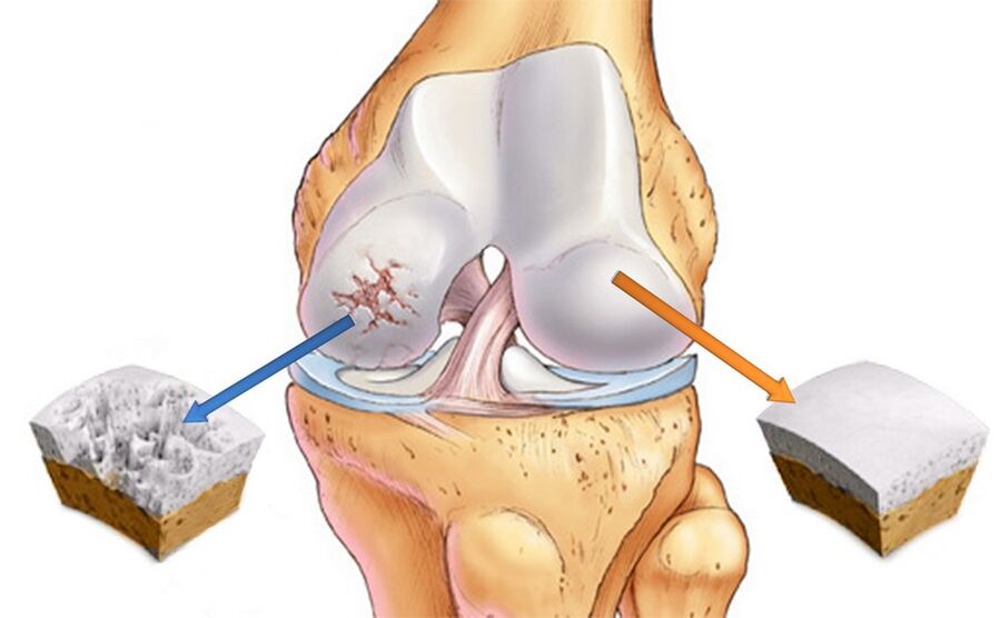 Articulație sănătoasă a genunchiului (dreapta) și afectată de artroză (stânga)
