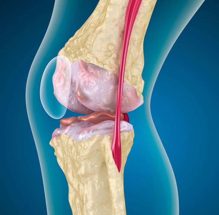 Artroza articulației genunchiului - o boală degenerativă-distrofică