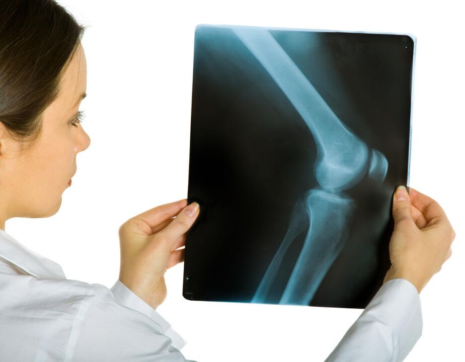 Radiografia articulației genunchiului va dezvălui prezența artrozei deformante